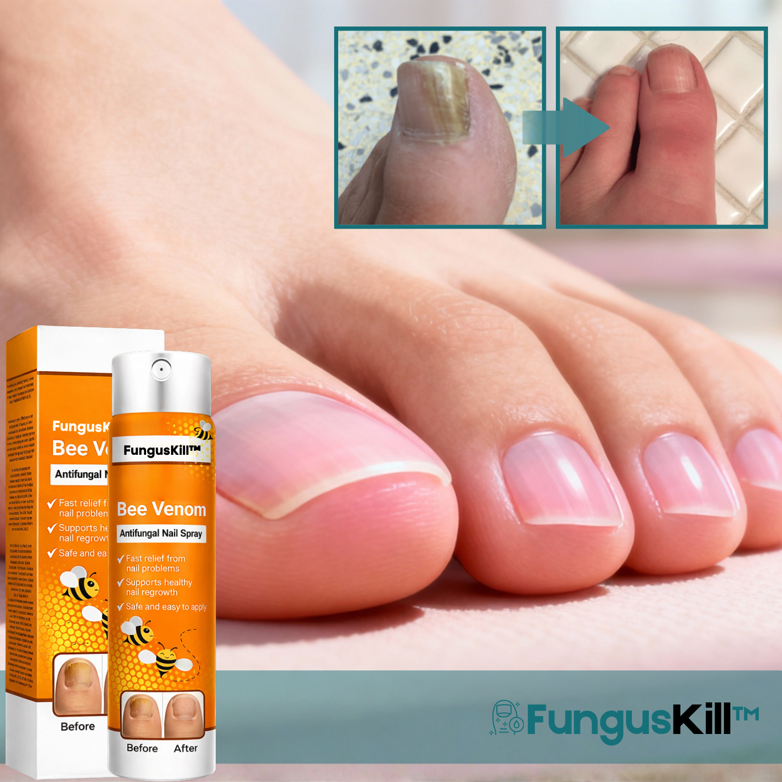 FungusKill™ Antifungal neglespray